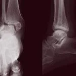 Broken Bones, Open Minds: My Journey Through Hong Kong’s Accessibility Gaps