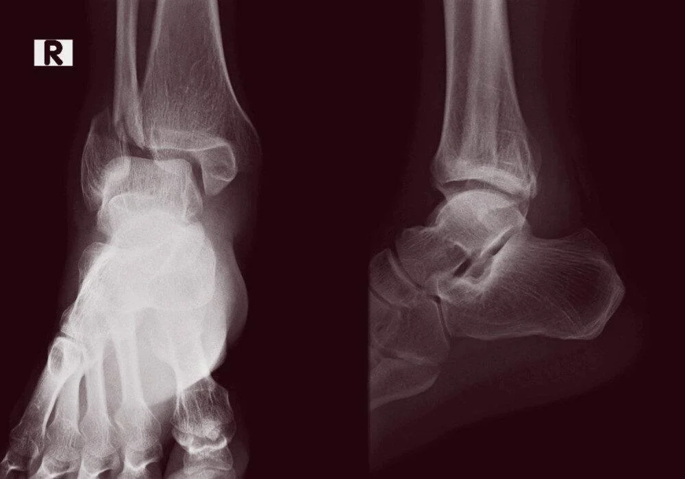 Broken Bones, Open Minds: My Journey Through Hong Kong’s Accessibility Gaps