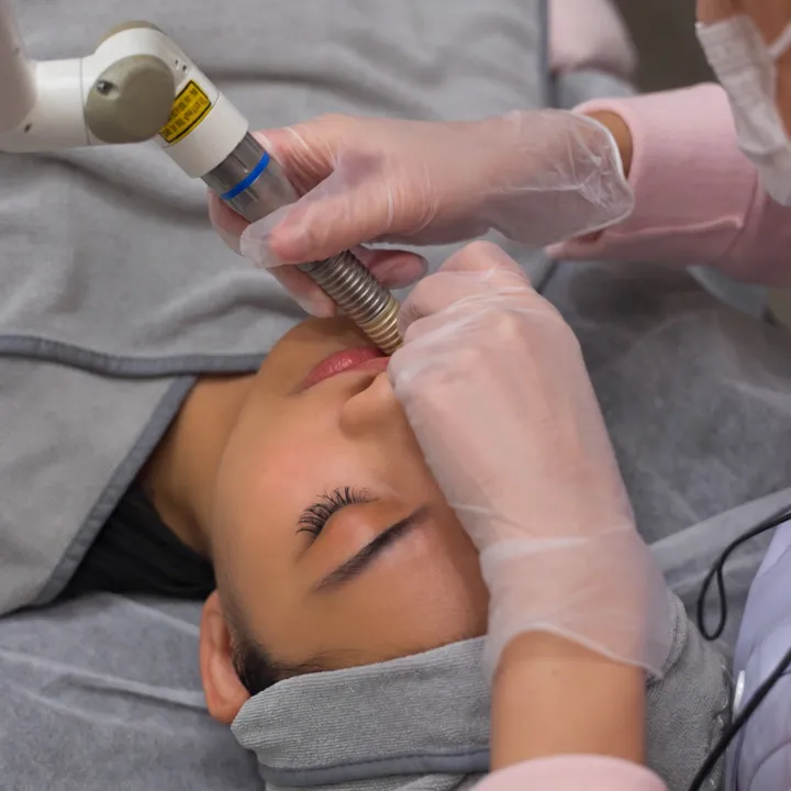 BMF Fotona Laser Tightening intraoral